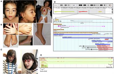 Whole Gene Deletion of EBF3 Supporting Haploinsufficiency of This Gene as a Mechanism of Neurodevelopmental Disease